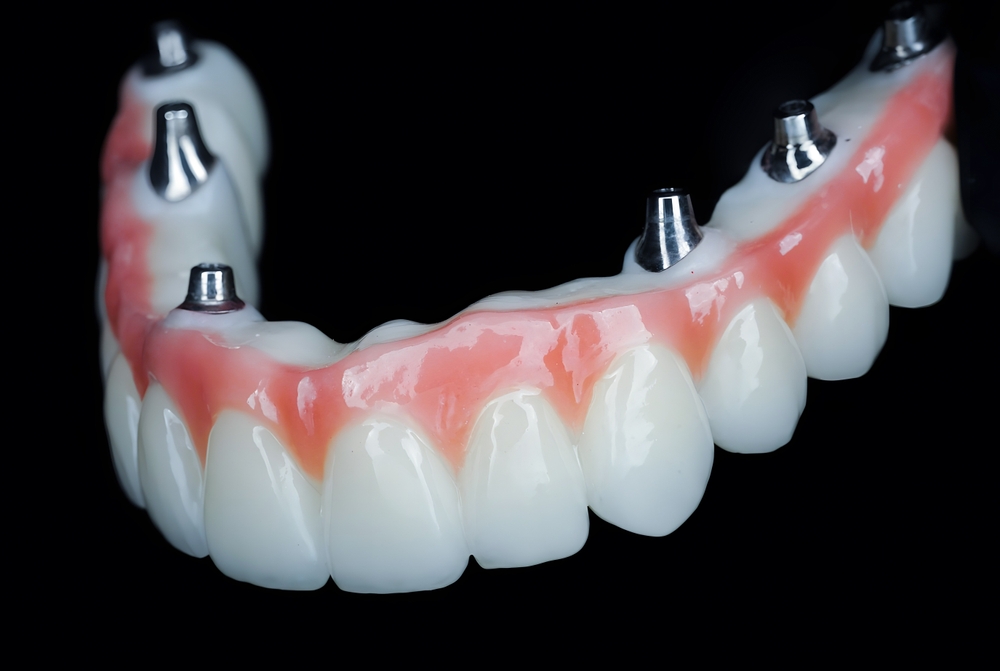 full arch dental implants concord ca
